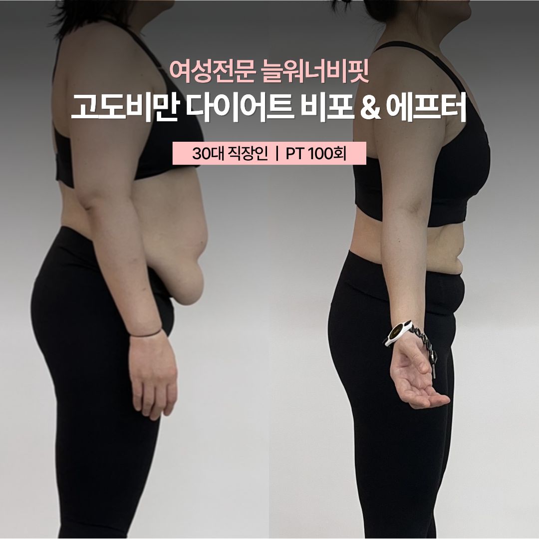 고도비만 다이어트 비포 애프터 — 30대 직장인 · PT 100회