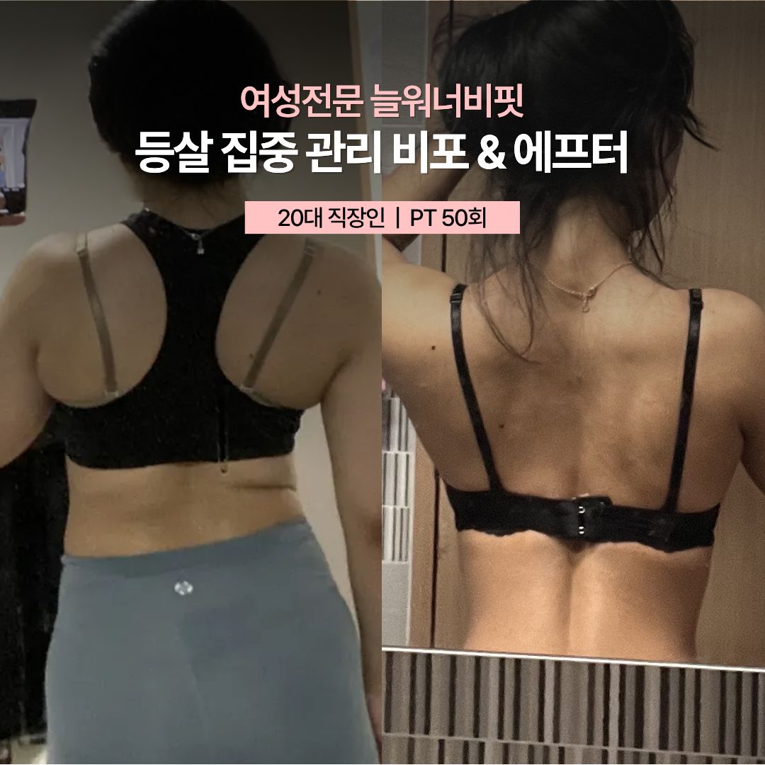 등살 집중 관리 비포 애프터, 20대 직장인 · PT 50회