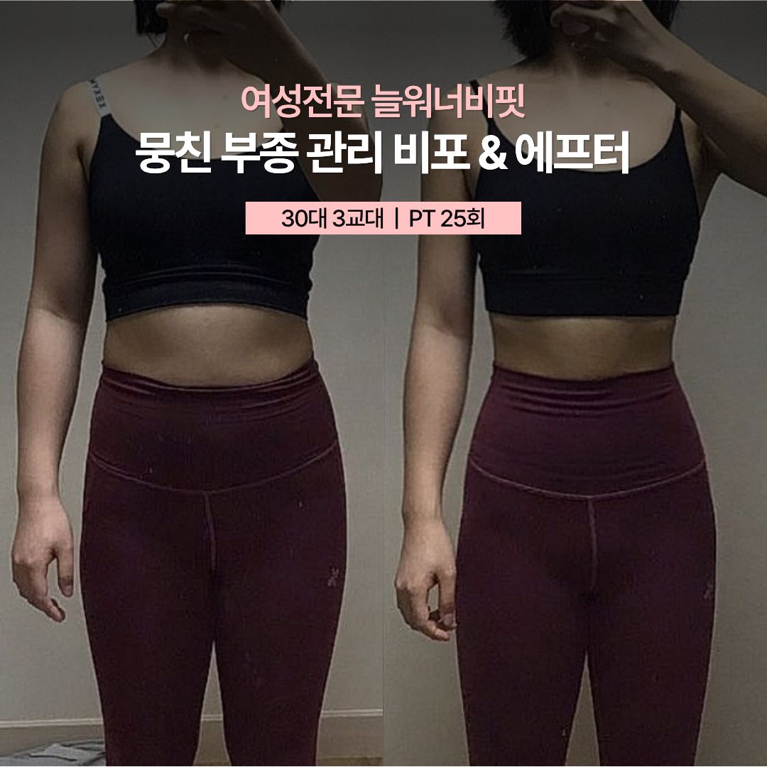 뭉친 부종 관리 비포 애프터, 30대 3교대 · PT 25회
