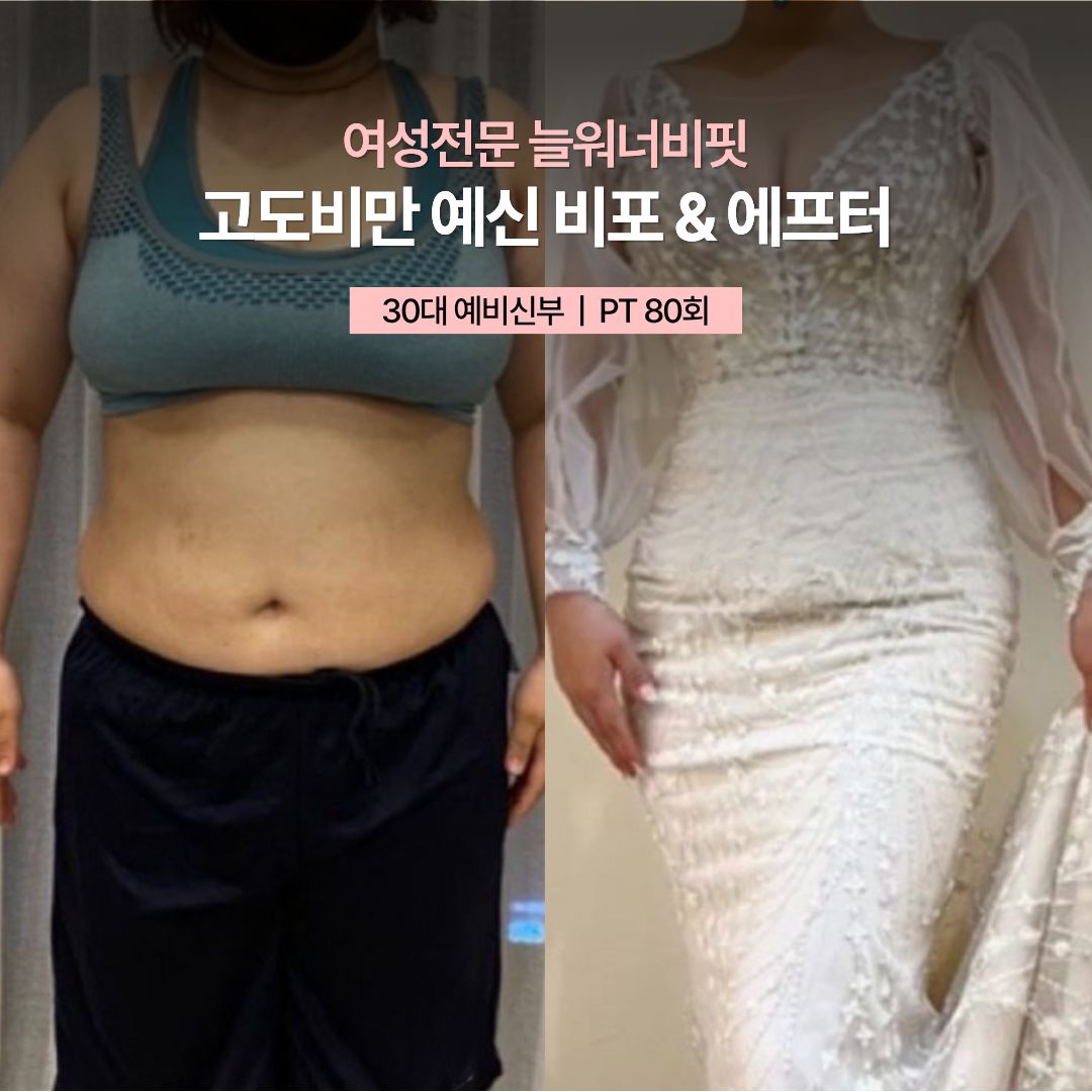 고도비만 예신 비포 애프터, 30대 예비신부 · PT 80회