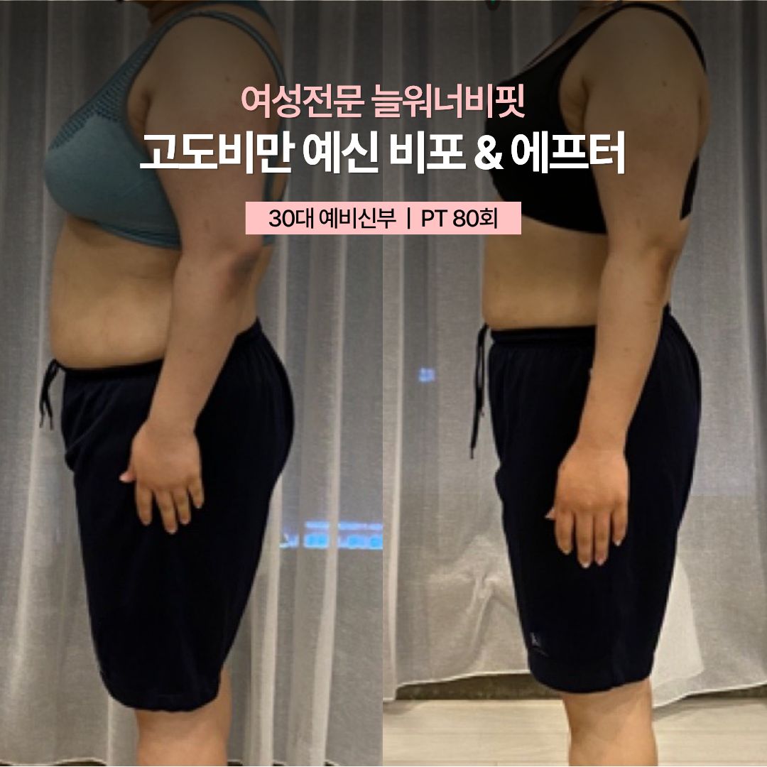 고도비만 예신 비포 애프터, 30대 예비신부 · PT 80회