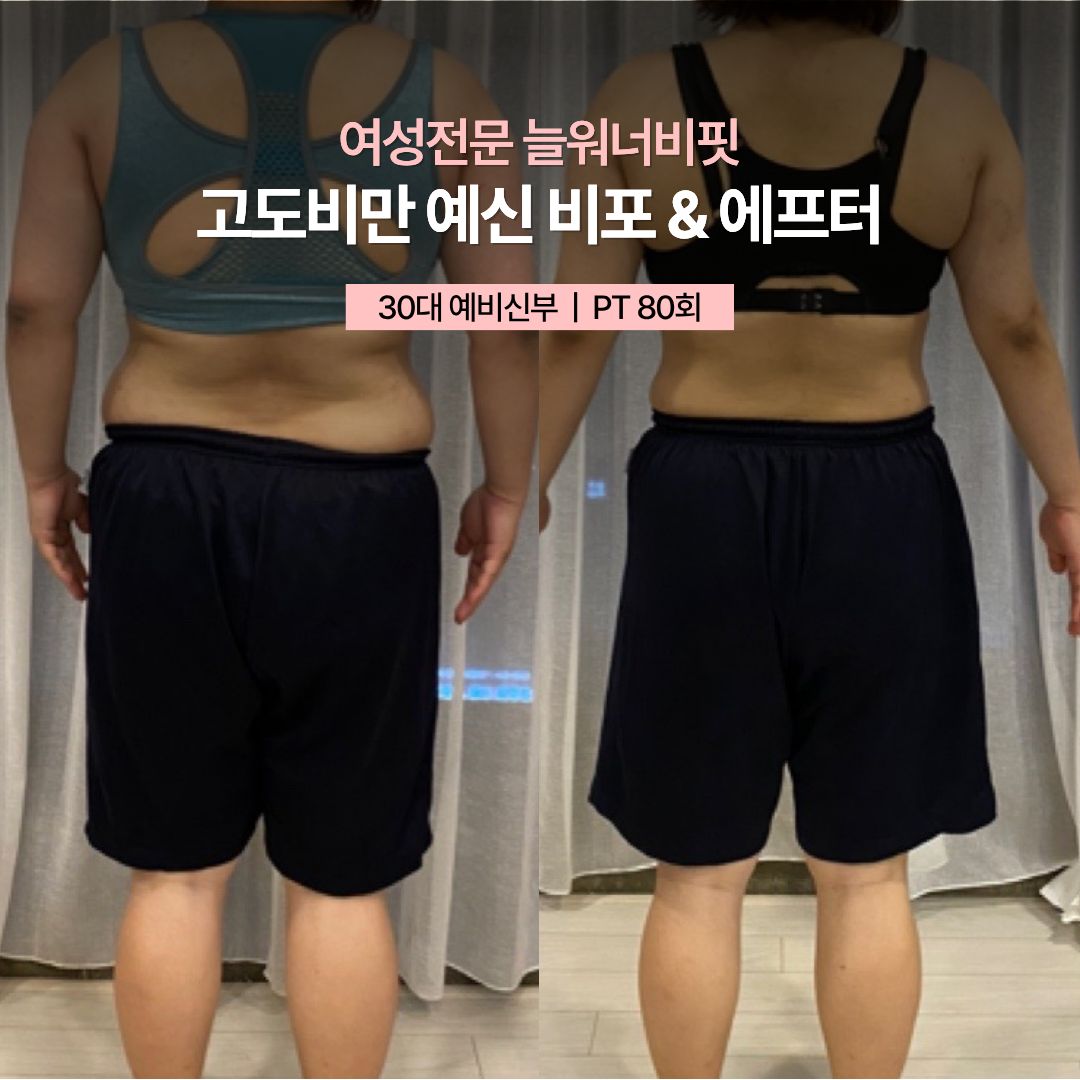 고도비만 예신 비포 애프터, 30대 예비신부 · PT 80회