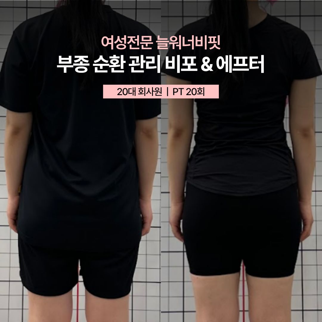 부종 순환 관리 비포 애프터, 20대 회사원 · PT 20회