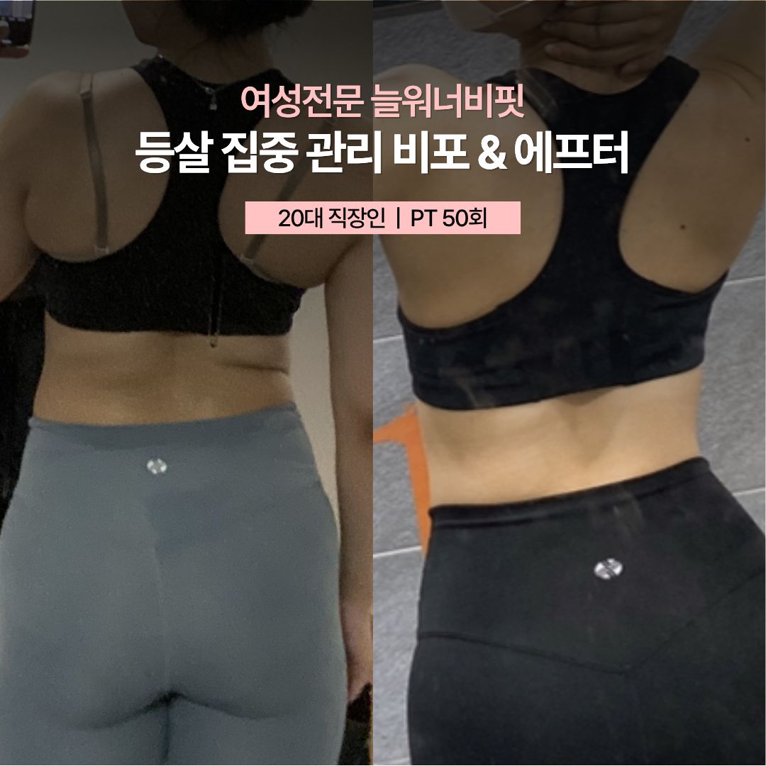 등살 집중 관리 비포 애프터, 20대 직장인 · PT 50회