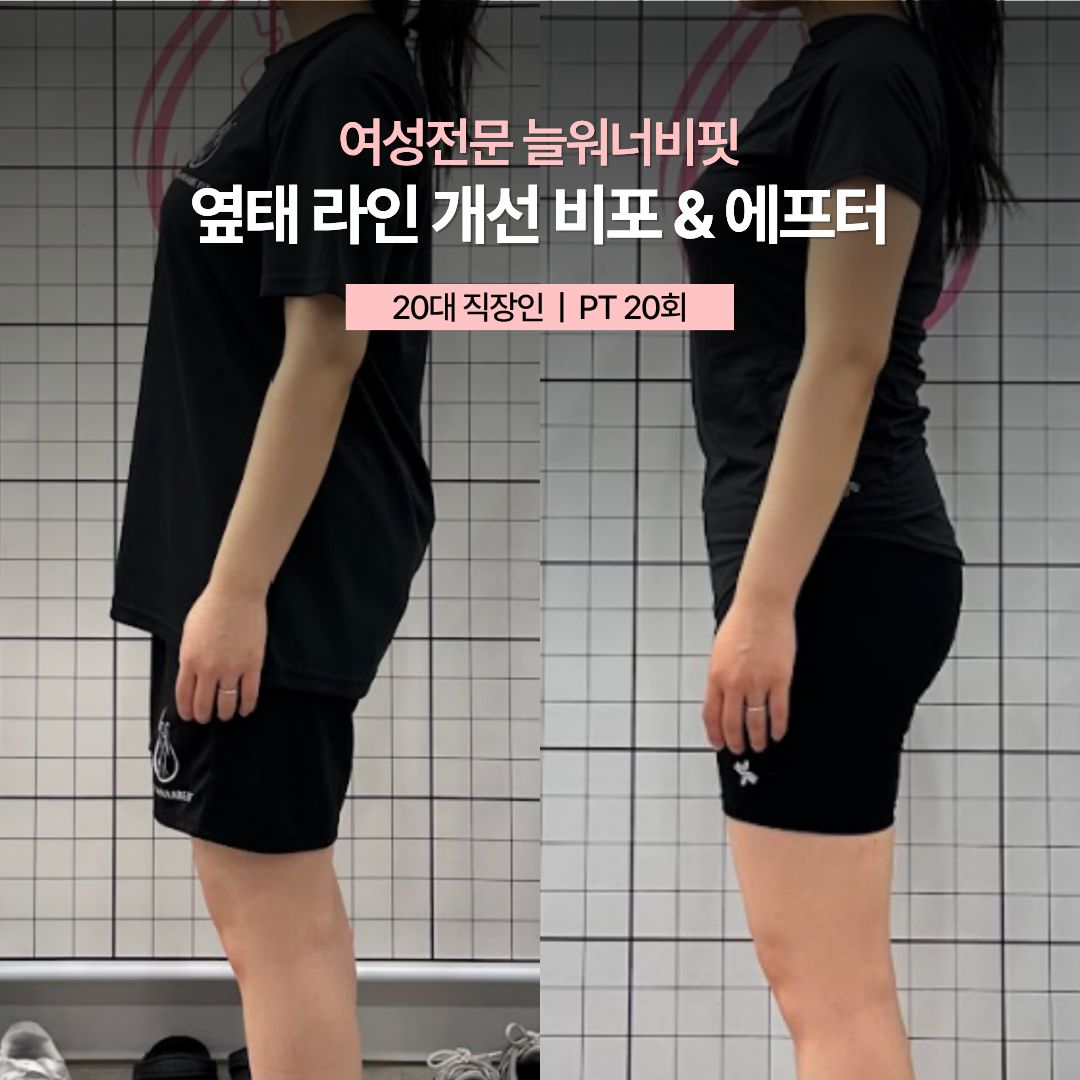 옆태 라인 개선 비포 애프터, 20대 직장인 · PT 20회